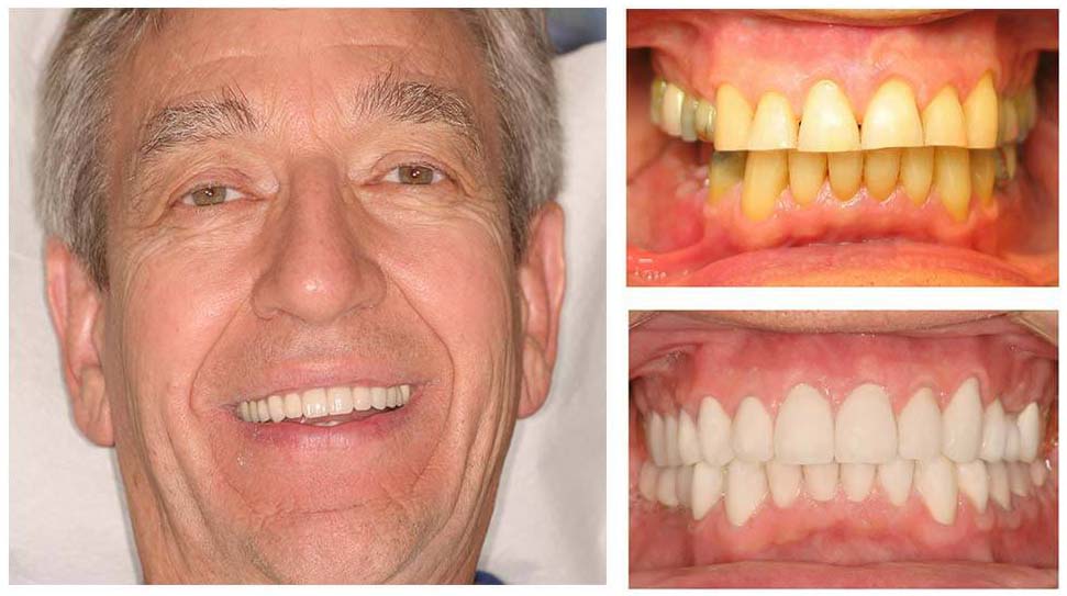 Full Smile Makeover in Scottsdale, Arizona Rejuvenate Your Smile