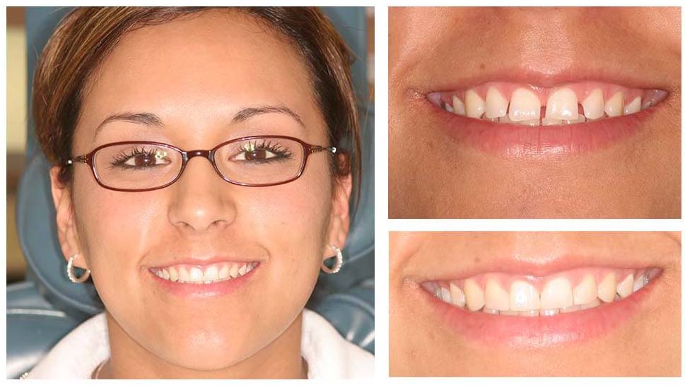 Full Smile Makeover in Scottsdale, Arizona Rejuvenate Your Smile